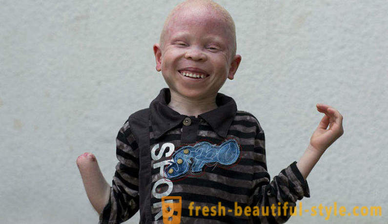 Kurb ajalugu Tansaania albiinode