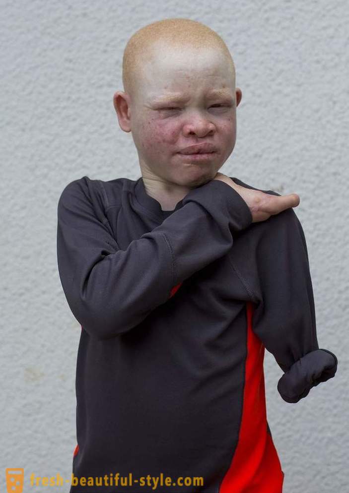 Kurb ajalugu Tansaania albiinode