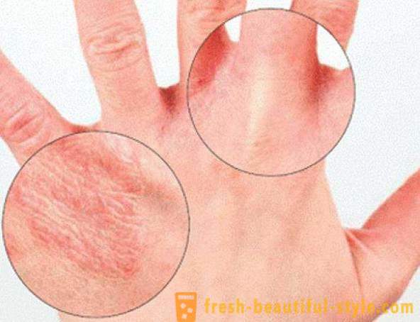 Kuiv nahk käed: Põhjustab. Väga kuiv nahk, mida teha?