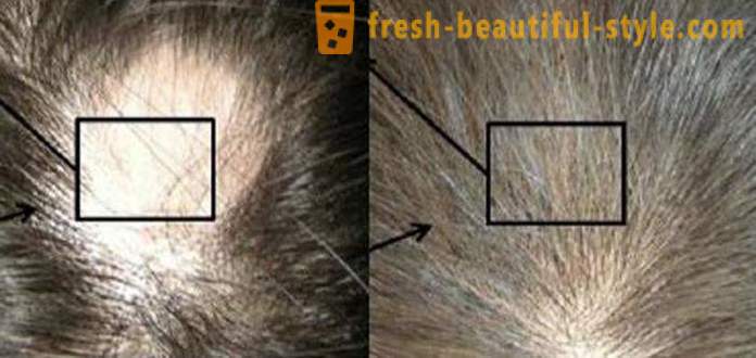 Mesoteraapia juuksed: Makeup tööriistad ja vastunäidustused