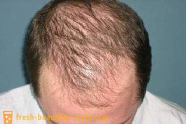 Kuidas kiirendada kasvu juuksed peas? Restaureerimine karvakasvu