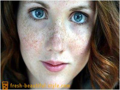 Hoolitse oma ilu ja noorust: põhjustab pigmentatsioon näol